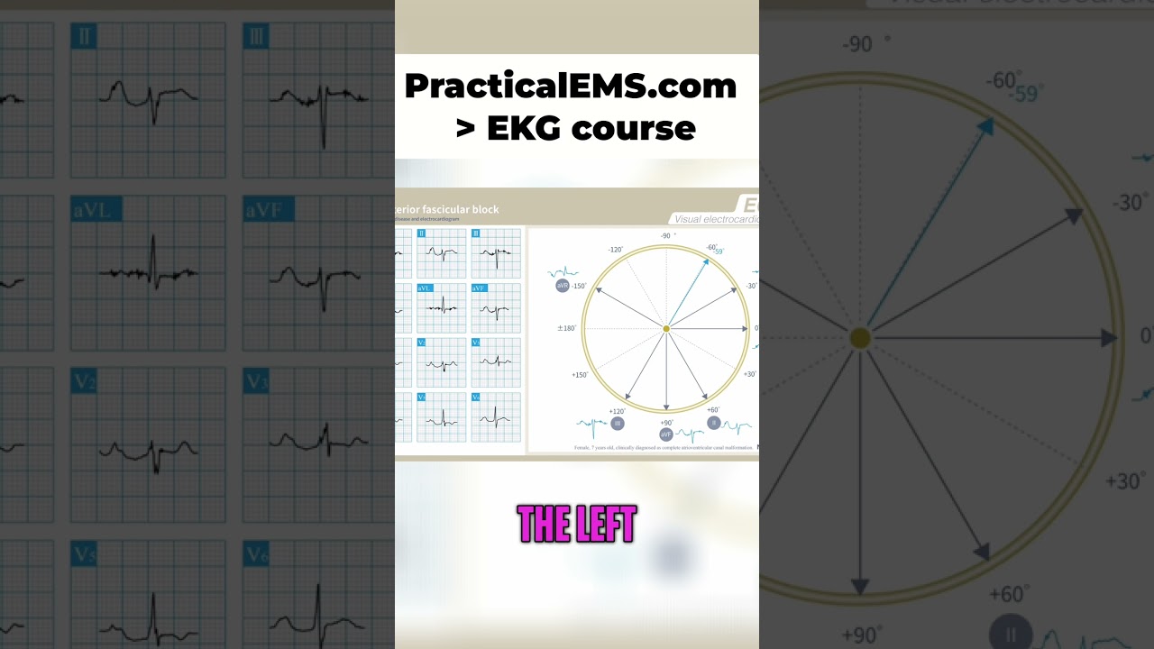 Left Anterior Fascicular Block: Understand the EKG Shift