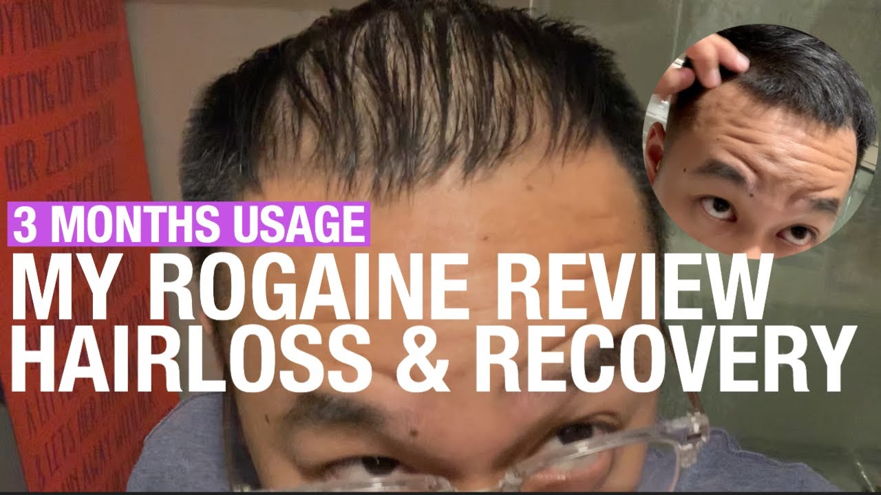 MY ROGAINE REVIEW: SERIOUS SHEDDING, HAIR LOSS & RECOVERY, 3 MONTHS USE