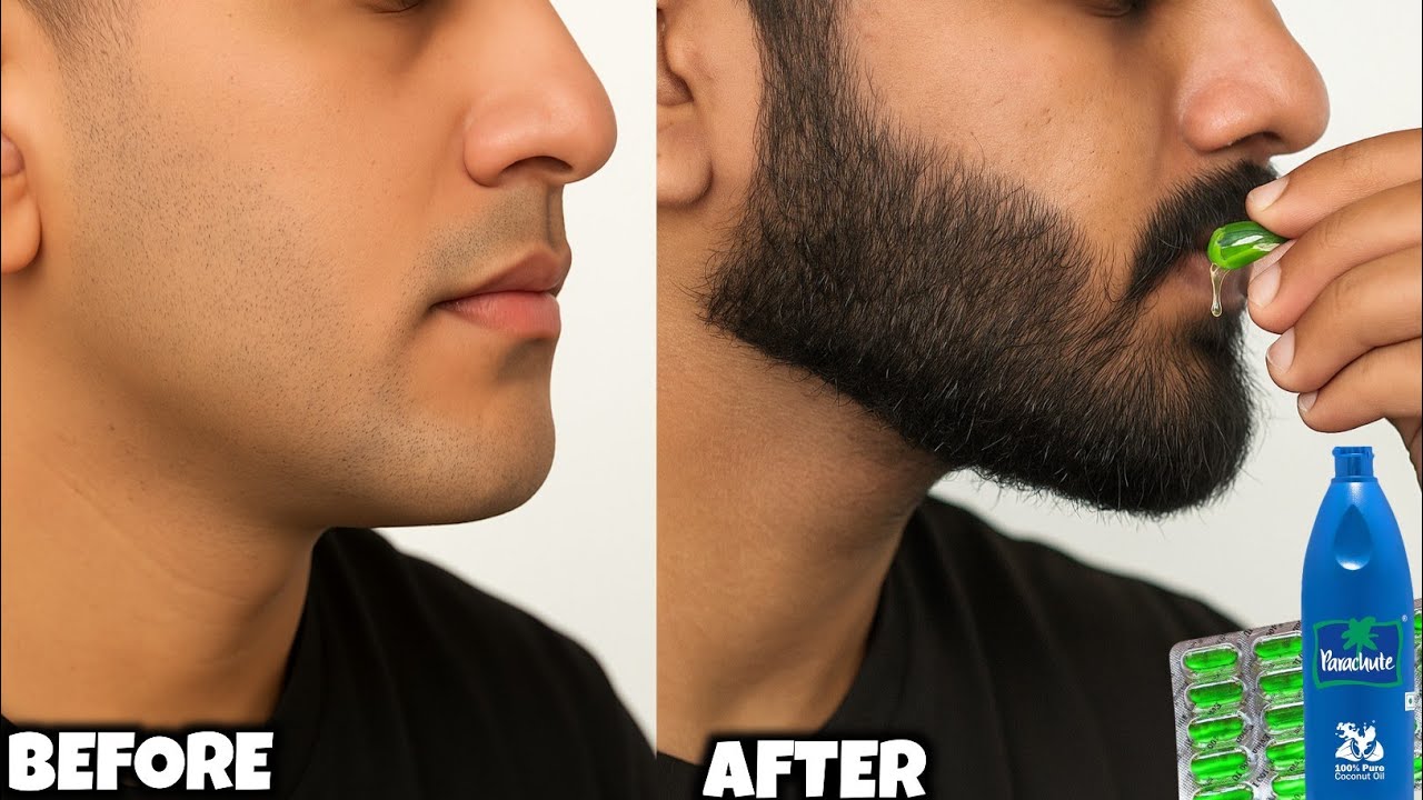 No Minoxidil! Just Evion 400 & Coconut Oil – Beard Growth Reality | vitamin e capsules for skin |
