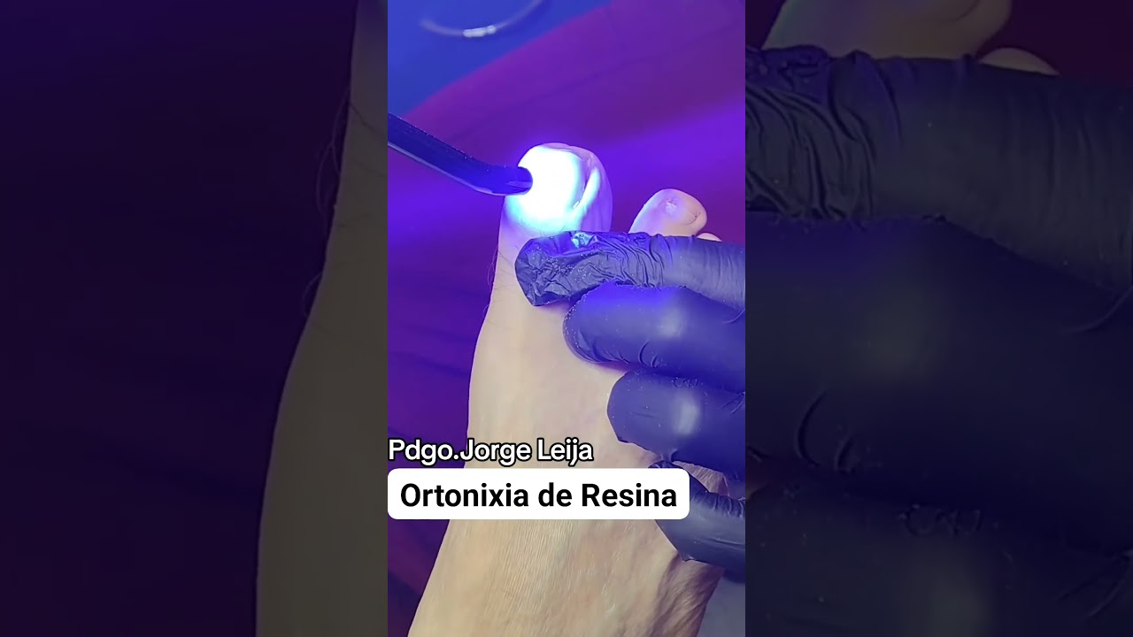 Ortonixia de resina en podología #podologo #podologia #uña #salud #pies