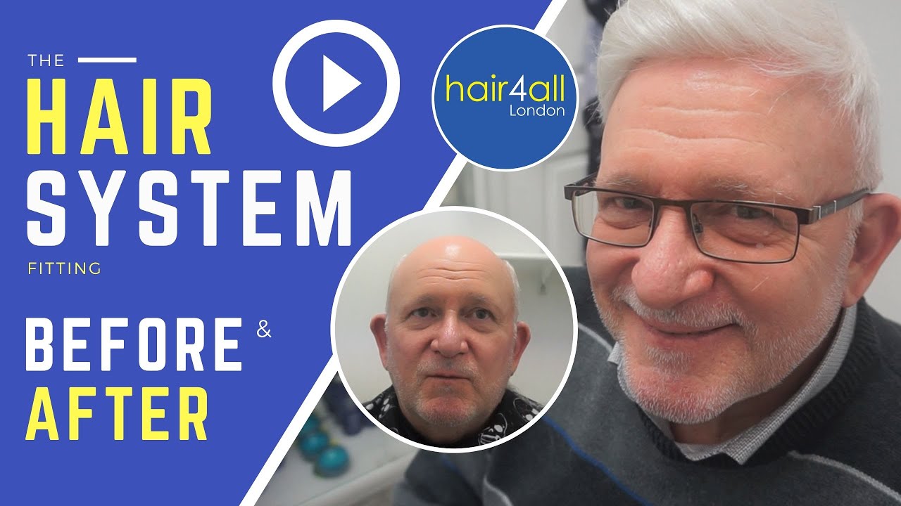 Before & After | Hair System | Non-Surgical Hair Replacement System for Men/Women | UK/USA/INTL