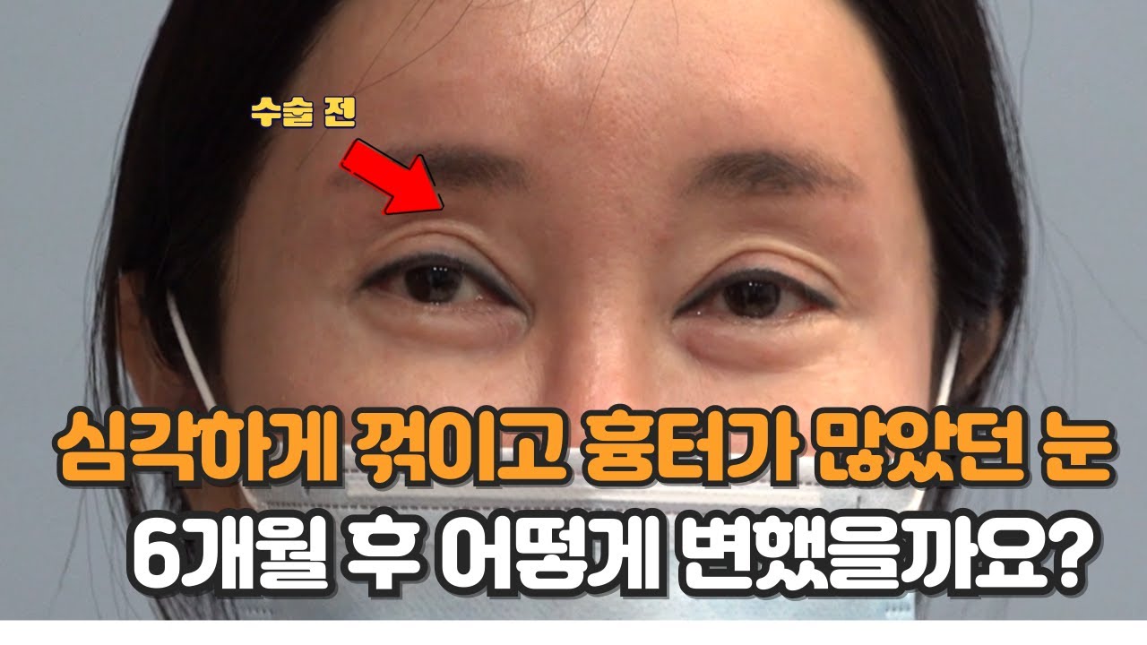 쌍꺼풀 재수술 전 심각하게 꺾이고 흉터가 많았던 눈, 6개월 후 어떻게 변했을까요?