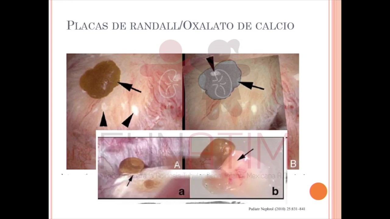 Urolitiasis