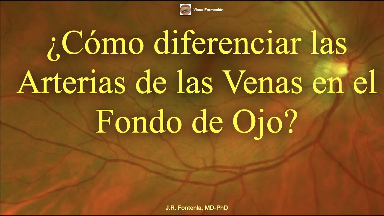 &iquest;C&oacute;mo diferenciar las Arterias de las Venas en el Fondo de Ojo?.