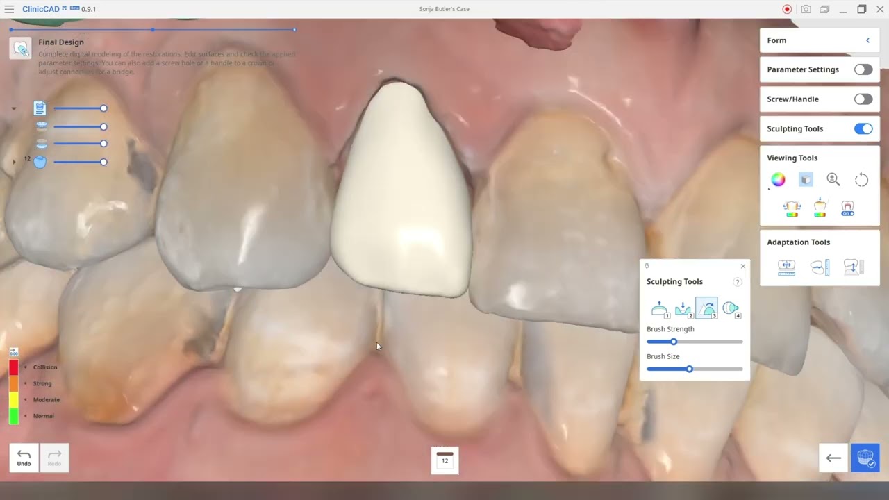 3D printed hybrid ceramic crown - full workflow