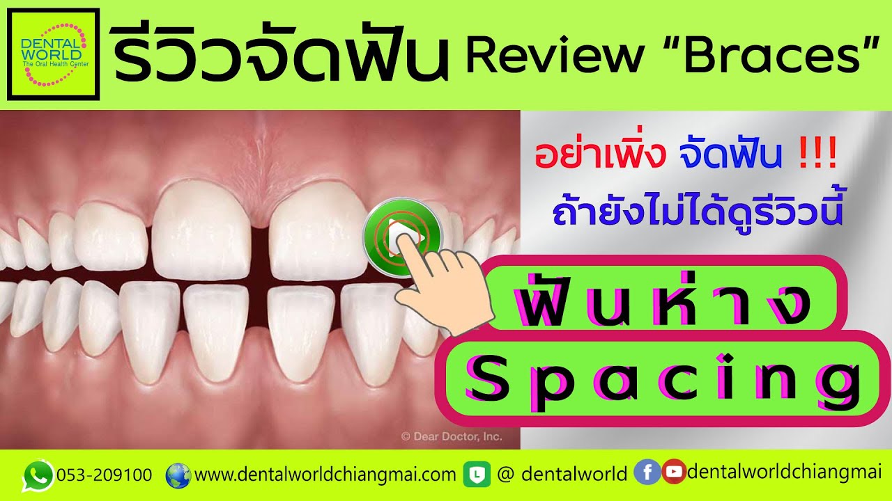 EP.51 รีวิวจัดฟันห่าง Spacing #จัดฟันเชียงใหม่ #จัดฟันเชียงใหม่ที่ไหนดี #chiangmaidentist #Braces