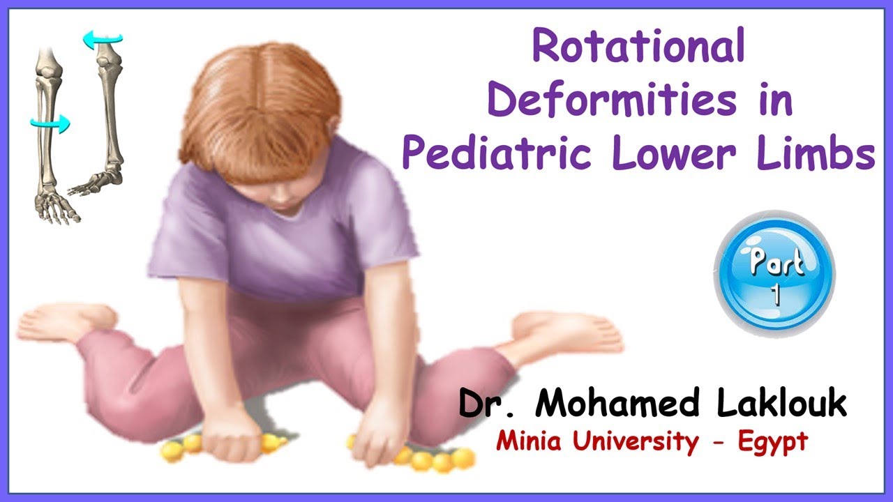 Rotational Deformities in Pediatric Lower Limbs (Part 1) | Dr. Mohamed Laklouk