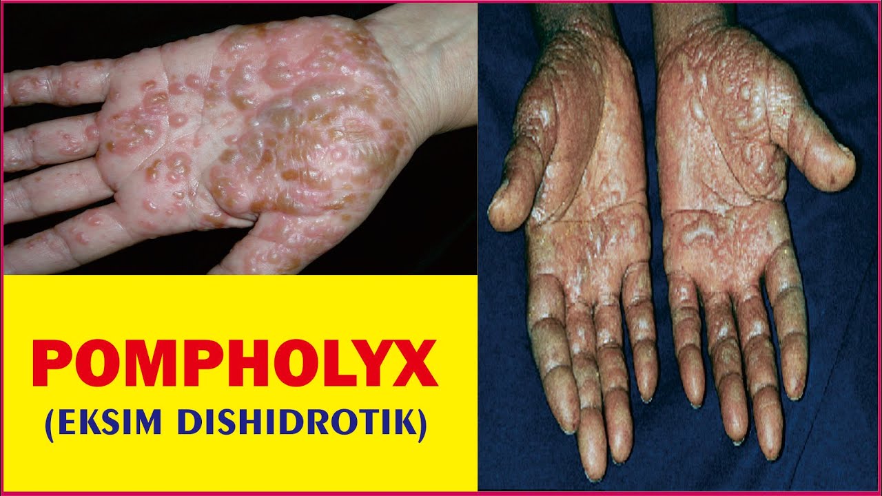 POMPHOLYX (EKSIM DISHIDROTIK), Definisi, Penyebab, Gejala dan Pengobatan