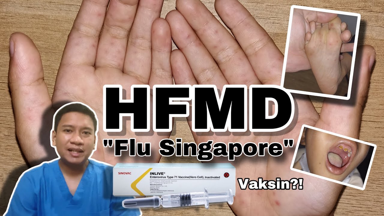 HFMD | Flu Singapura pada Anak