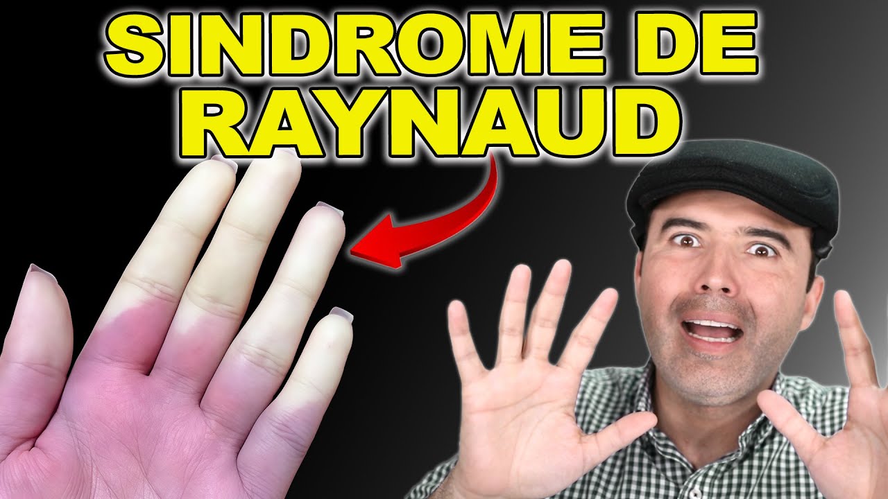 SÍNDROME DE RAYNAUD Y LUPUS: CÓMO IDENTIFICAR LOS CAMBIOS DE COLOR EN TUS MANOS