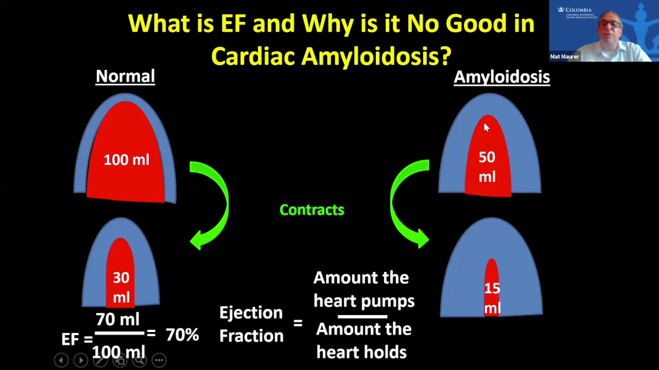Cardiac Amyloidosis by Dr. Mat Maurer