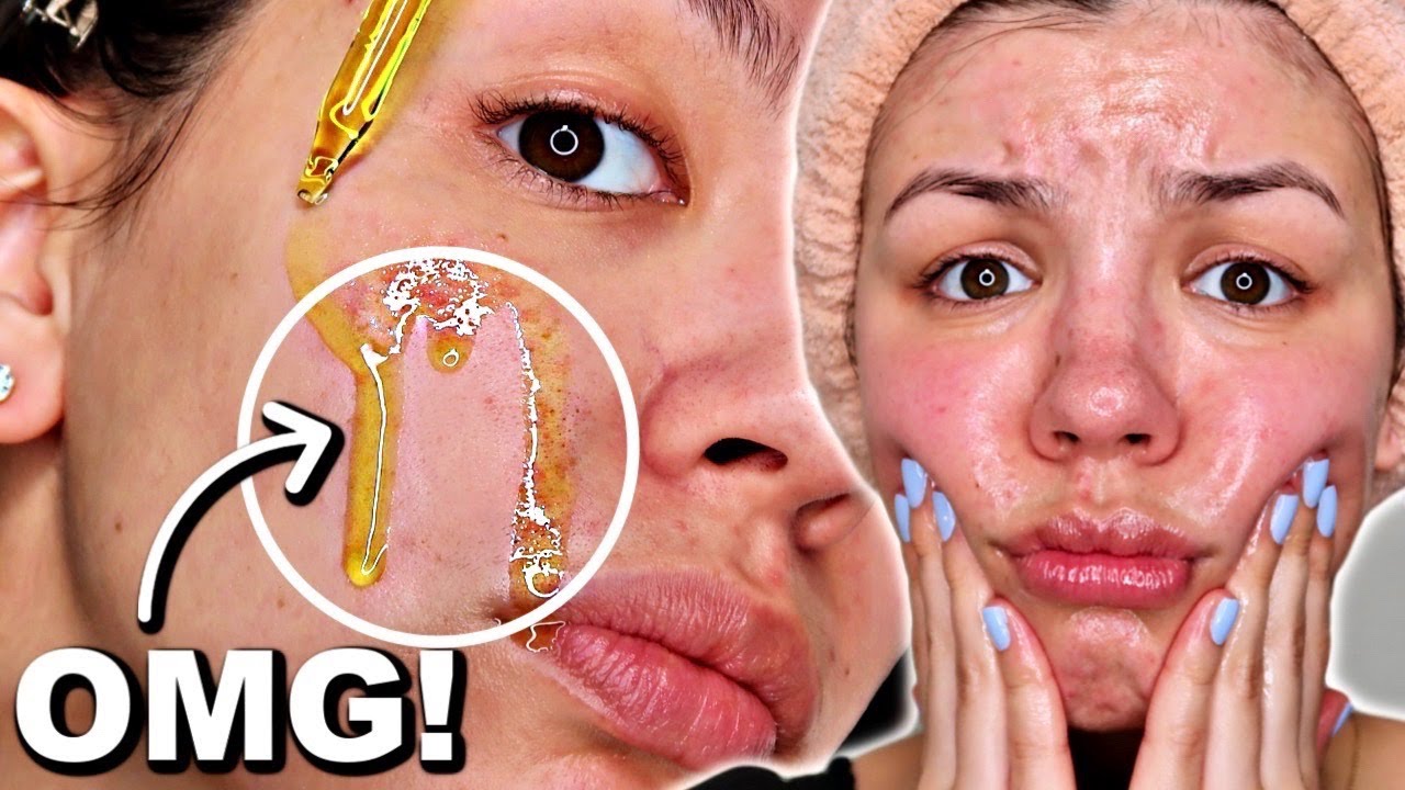 THE OIL CLEANSING METHOD ON OILY SKIN | OIL CLEANSING BEFORE AND AFTER