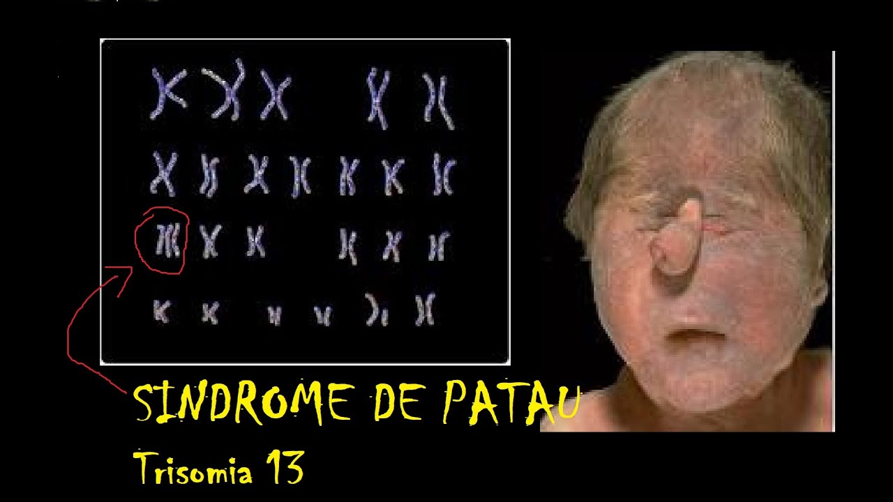 Síndrome de Patau (Trisomía 13)