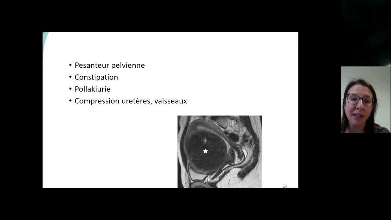 Fibromes Ut&eacute;rins