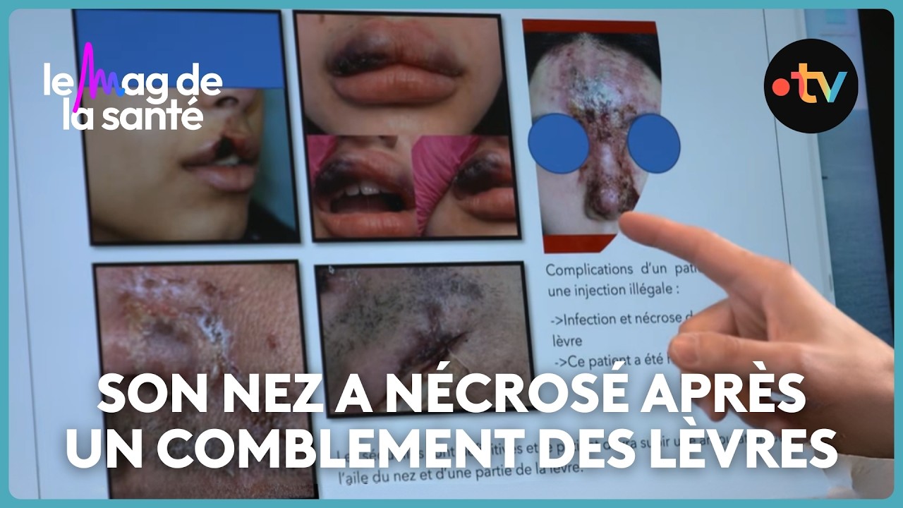 Les dangers des injections d'acide hyaluronique dans les lèvres