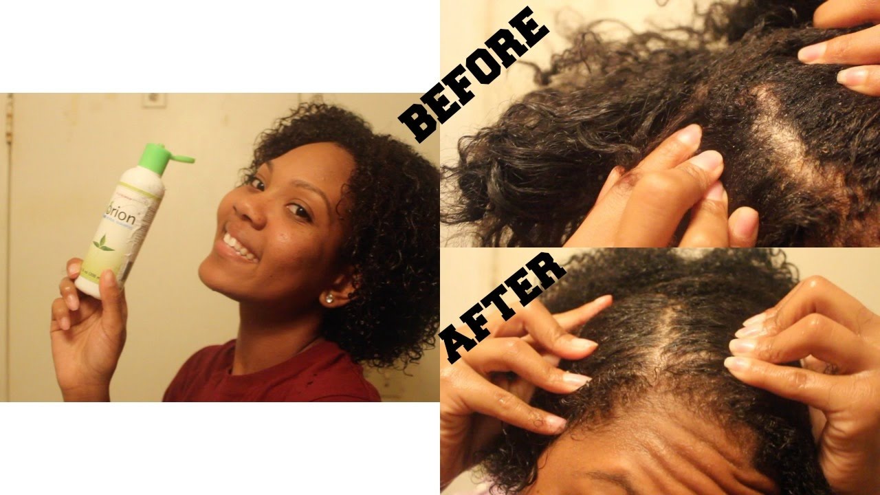 How To Clear Up Scalp Psoriasis using Sorion Herbal Shampoo