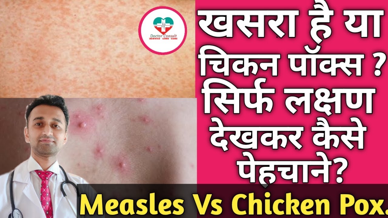 Measles Vs Chicken Pox!  How To Differentiate?? खसरा और चिकन पॉक्स मे क्या फरक होता है? HINDI.