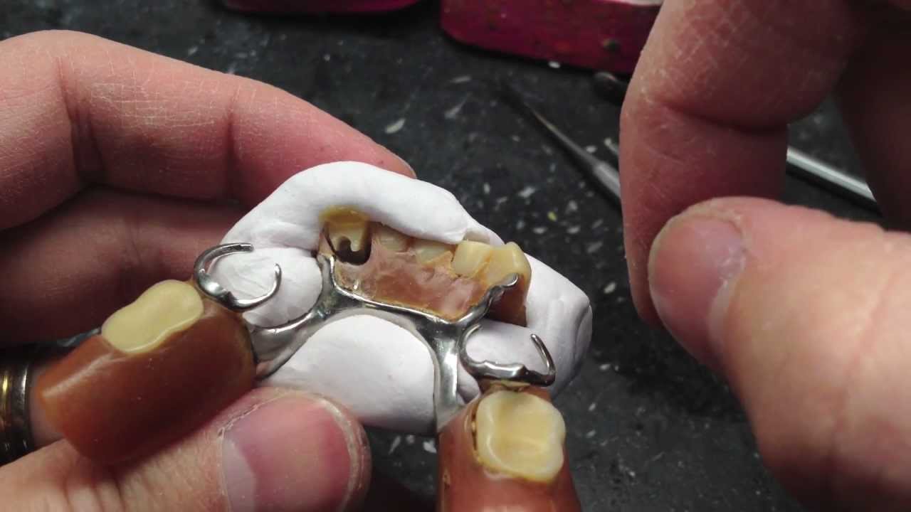 Add A Tooth To A Partial or Denture (for Ortho Labs)