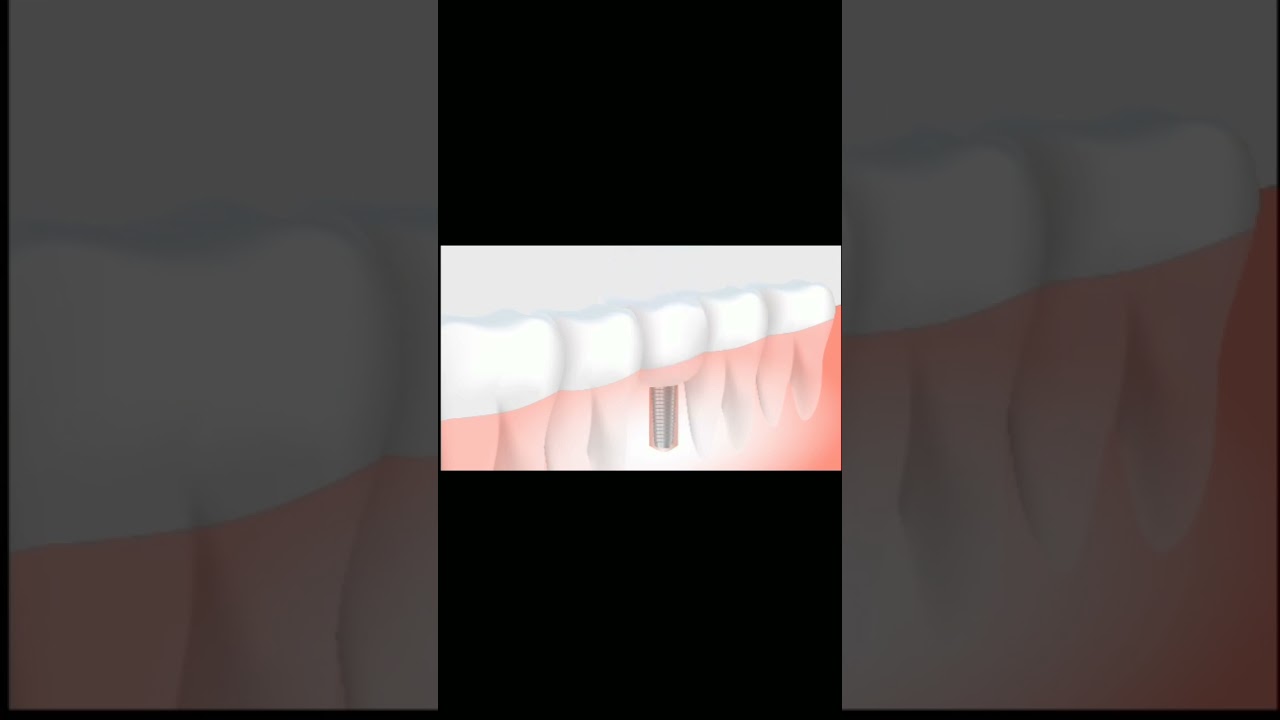 Dental Surgery Explained | Tooth Treatment & Oral Care | Medical Video. 