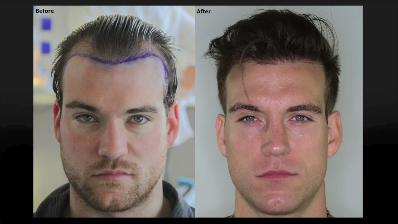 Dense Packing FUE Hair Restoration - AlviArmani