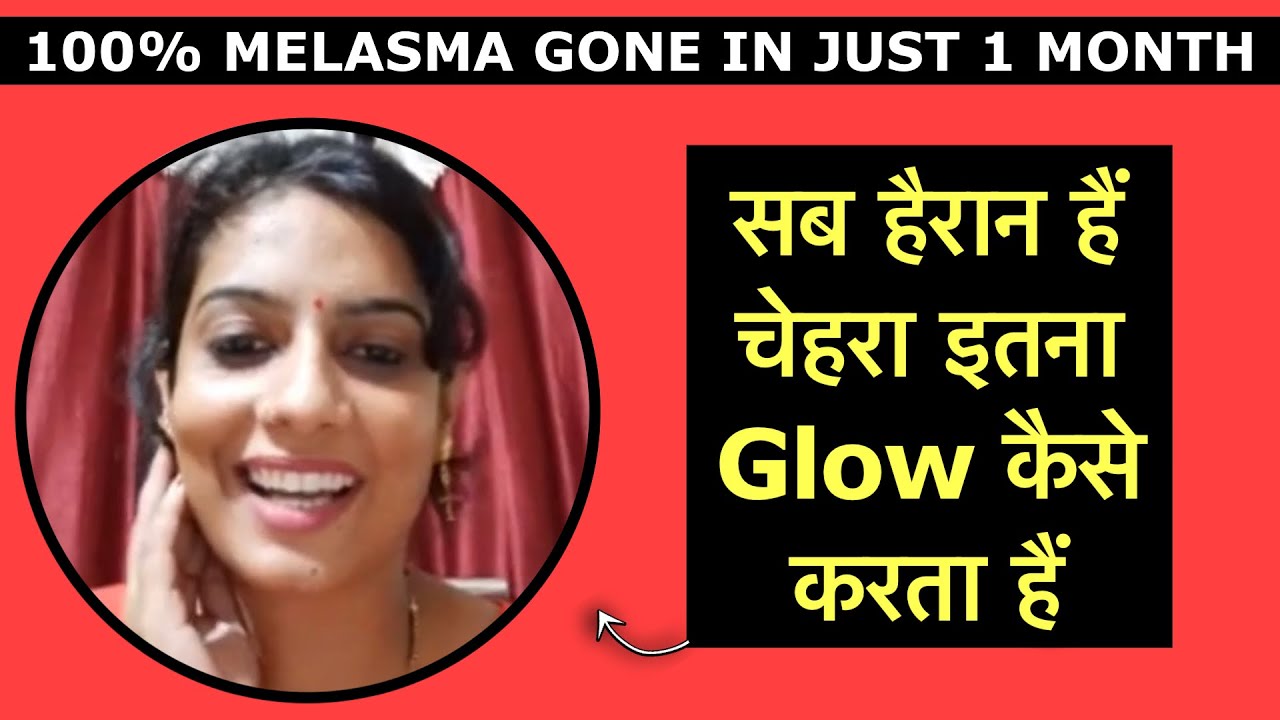 100% Melasma gone in just 1 month. Now Face is Glowing. झाइयाँ 100% चली गयी अब चेहरा Glow करता हैं