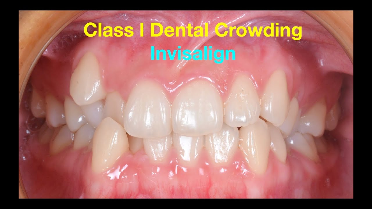 Treatment of Class I Dental Crowding with Invisalign｜【Chris Chang Ortho】CC751