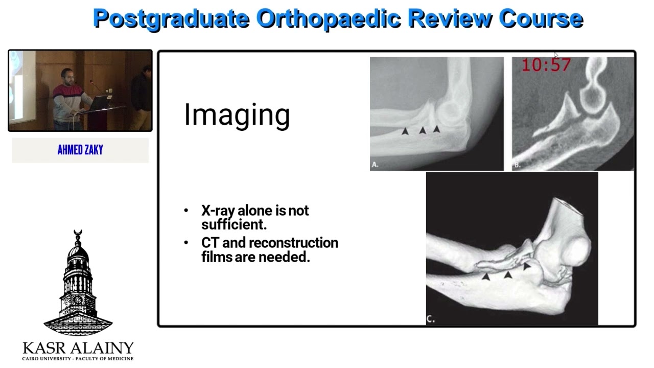 11- Fractures around elbow - Ahmed Zaki