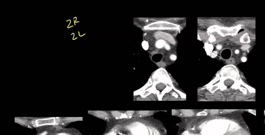 Mediastinal anatomy and nodal stations on CT