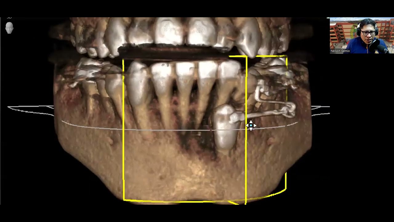Tracción canino retenido inferior