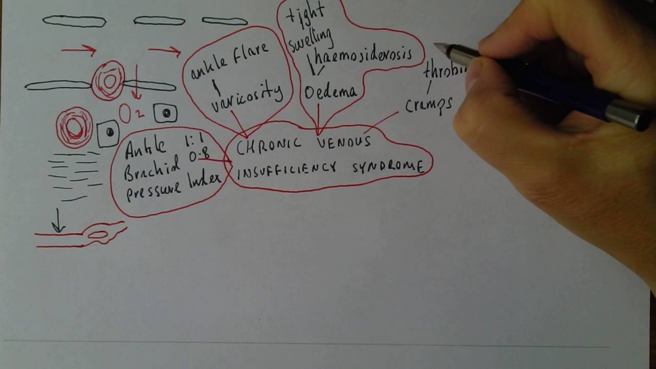 Chronic Venous Insufficiency 4, Clinical features