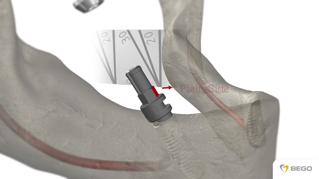 BEGO Implant Systems – MultiPlus restoration/ MultiPlus-Versorgung