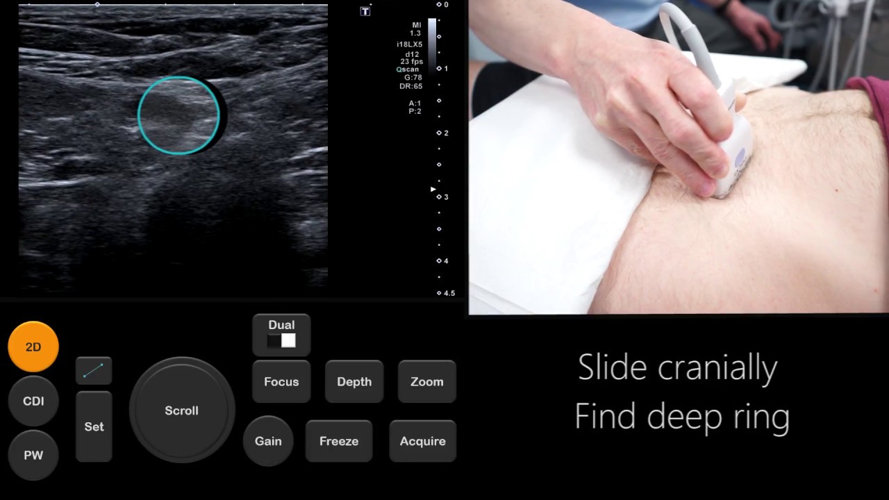 Учебное пособие по УЗИ: оценка паховой/бедренной грыжи | Radiology Nation