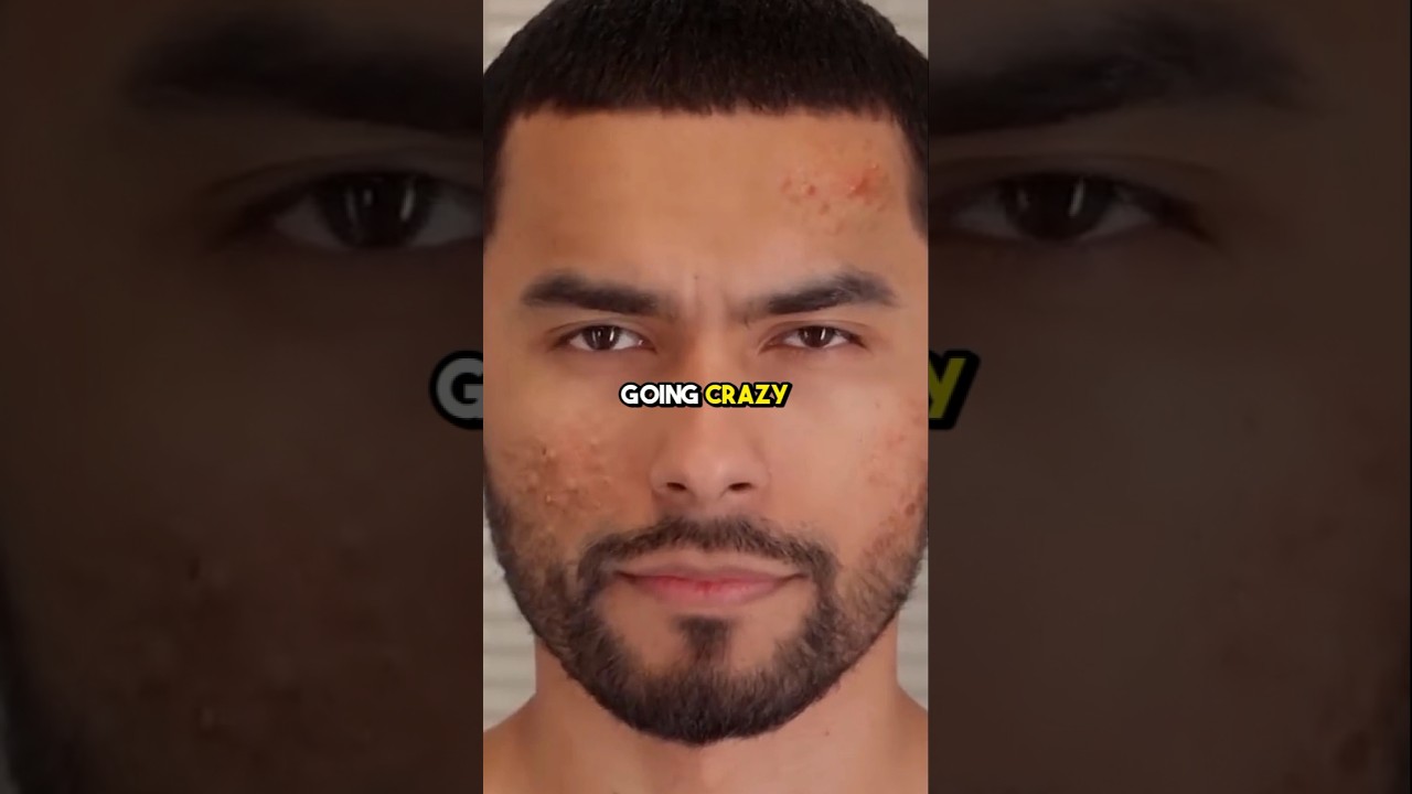 Zuniga On Stop Forehead Acne Forever.