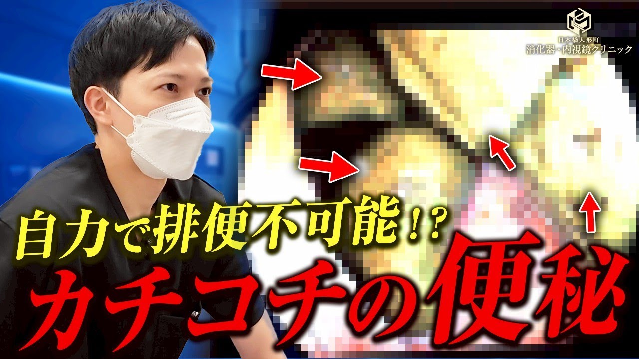 【閲覧注意】「背中まで便が詰まってる感覚&hellip;」30代女性が自力排便不能に。内視鏡で見えたのは&rdquo;石&rdquo;のように固まった大量の便!?