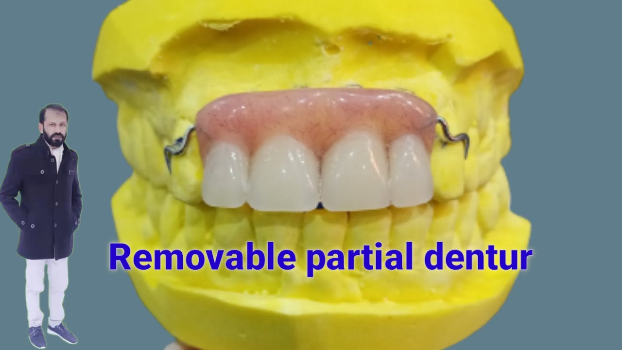 Temporary Removable Partial Denture || Immediate RPD by Haider ||Dental Art by Haider..............