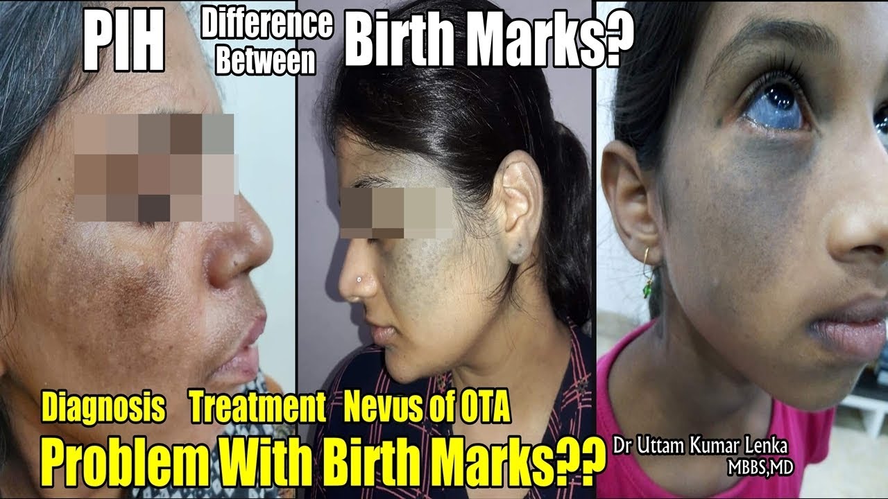 Cause and Treatment of blue Birth Mark on face and eyes?What is Nevus of OTA?Treatment In Hindi