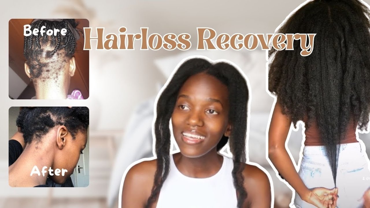 REAL HAIR LOSS RECOVERY (with PICS) BALD SPOTS to HAIR GROWTH | Understanding the Hair Growth Cycle
