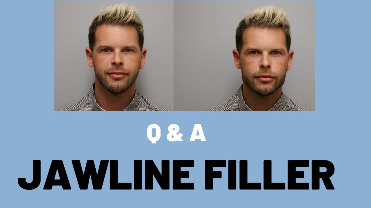 All Jawline Filler Questions Answered
