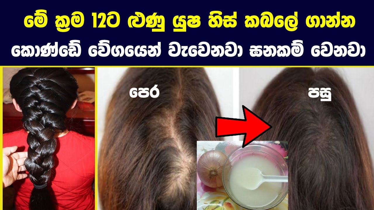 මේ ක්‍රම 12 ට ළුණු යුෂ ගෑවොත් කොණ්ඩේ වැවෙන වේගය හිතාගන්නවත් බැරි වේවි | Onion Juice For Hair Growth
