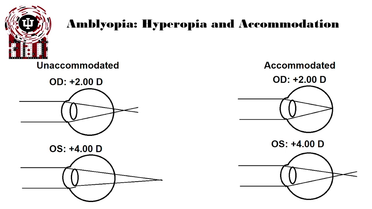 Ocular Disease and Refractive Error Spotlight: Amblyopia