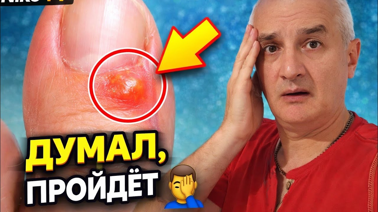 У меня воспалился палец - вот что ПОМОГЛО (паронихия) 🩹