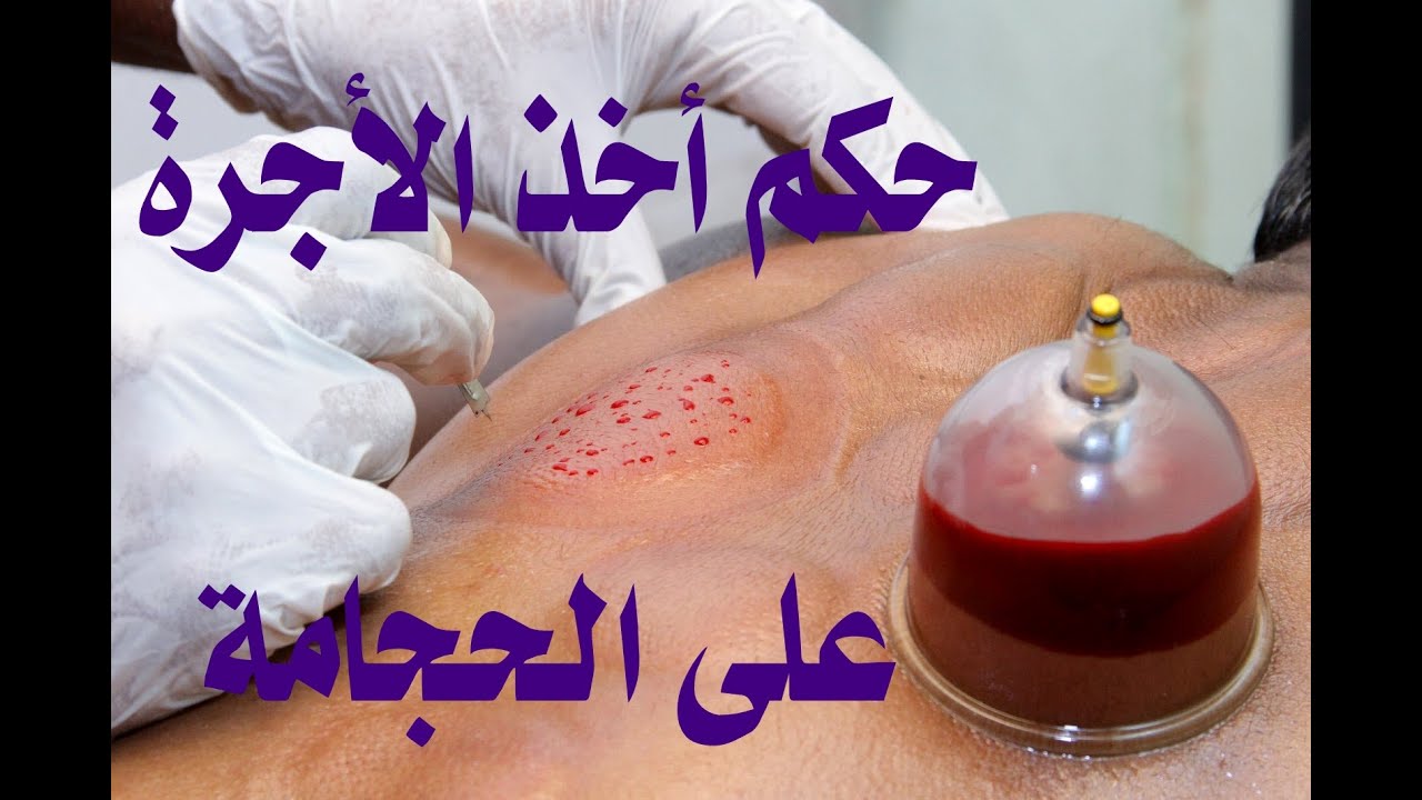 حكم أخذ الأجرة على الحجامة للشيخ فركوس الجزائري
