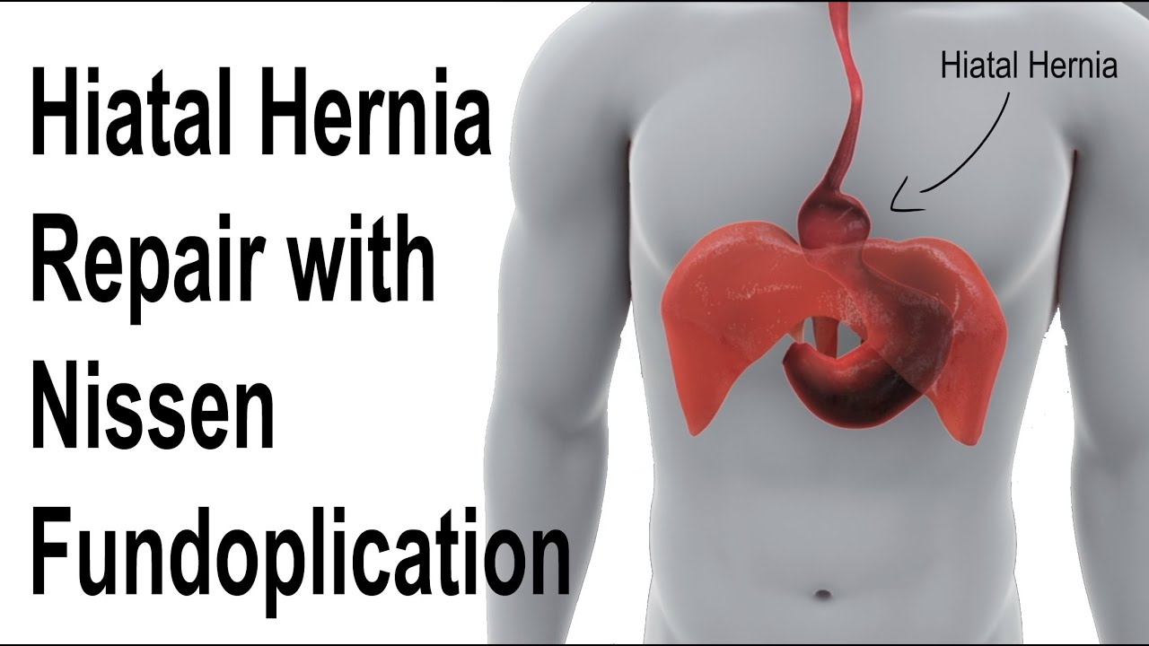 Hiatal Hernia Repair with Nissen Fundoplication to Treat Reflux Animation