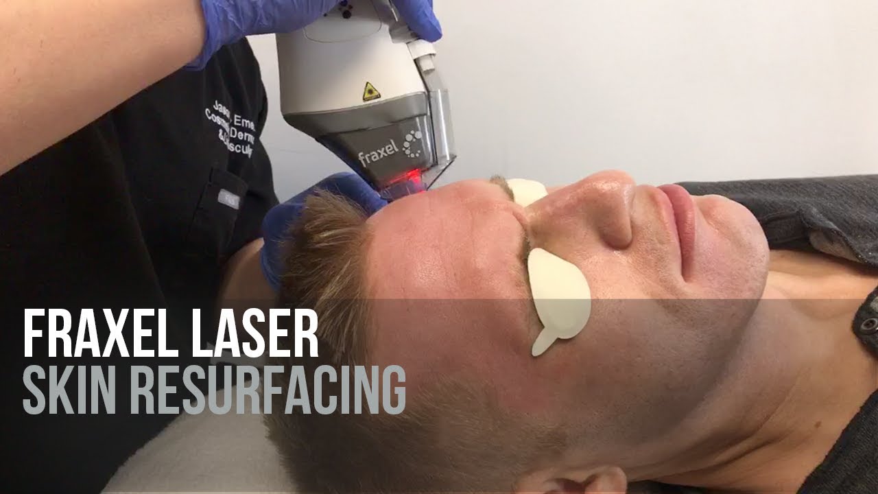 Fraxel Laser Treatment for Skin Resurfacing | LIVE