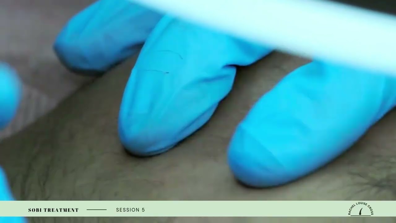 Dr Sobi Electrolysis Journey - Session 5