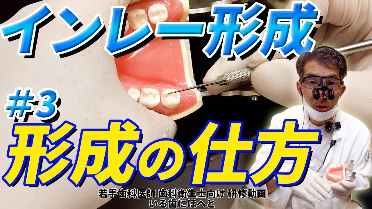【左下7番（大臼歯）のインレー形成#3】インレーの形成とデュラシールについて