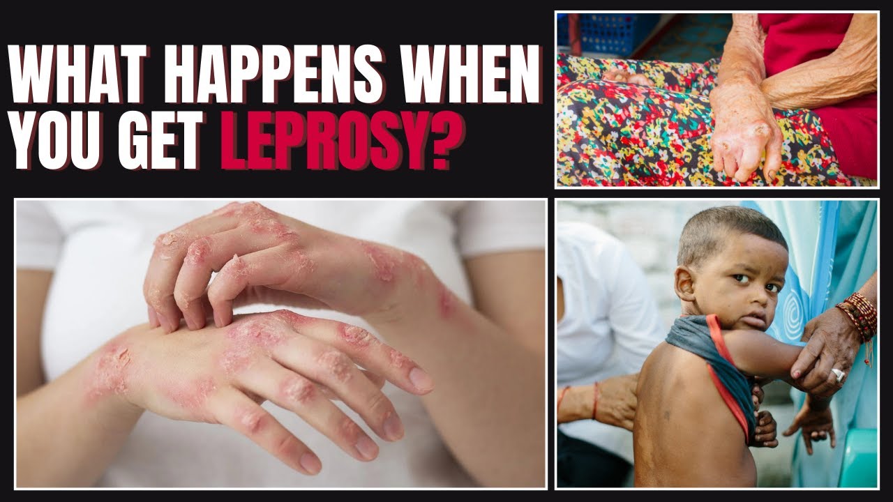 Leprosy: Symptoms, Types, and Who's at Risk! Everything You Need to Know
