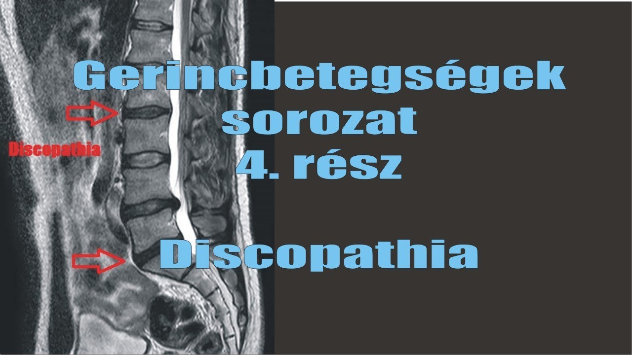 Gerincbetegségek sorozat 4. rész: Discopathia