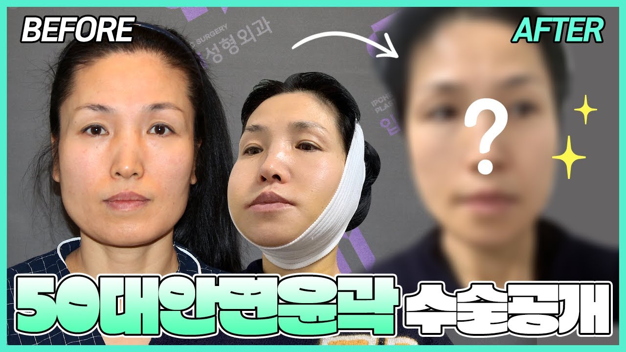 50대안면윤곽(사각턱+앞턱) 수술 전 대공개~!🙌🏻