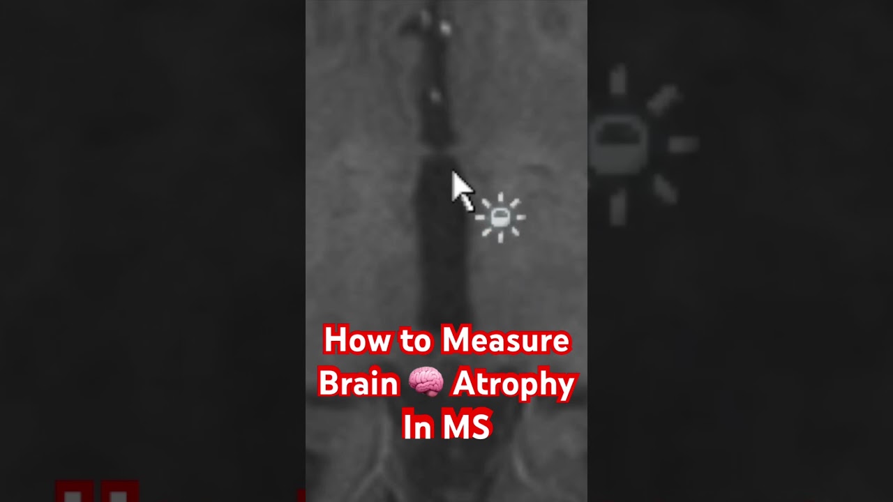 Poor Man's Way to Measure MS Brain 🧠 Atrophy (shrinkage)